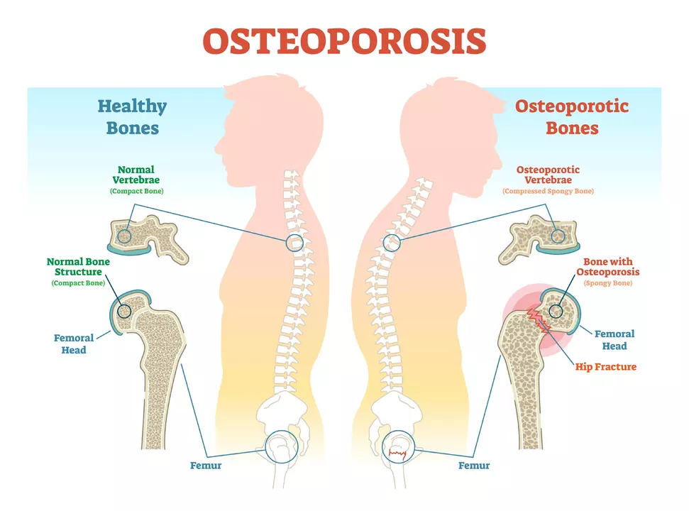 The Relationship Between Osteoporosis and Kidney Disease